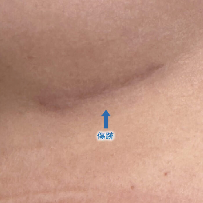 ６ヶ月後の肋軟骨の採取部分の傷跡