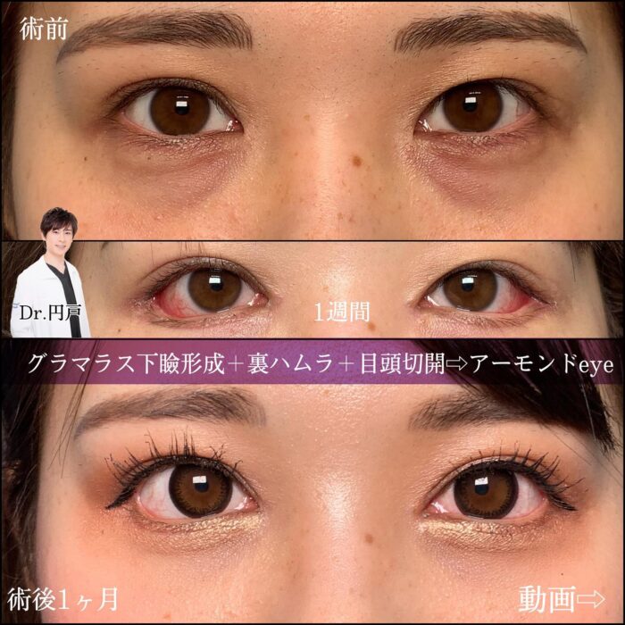 グラマラスライン形成と裏ハムラ法と目尻切開の症例写真