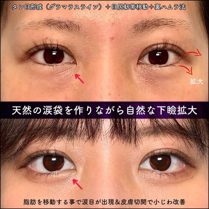 タレ目形成と目尻切開と裏ハムラ法の症例写真