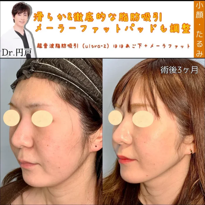 小顔の脂肪吸引とメーラーファット（円戸）