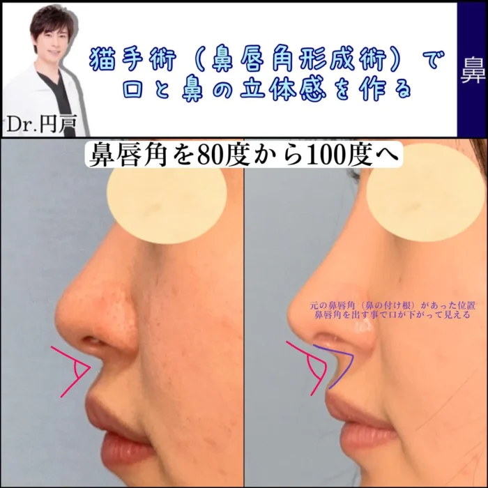 猫手術（鼻唇悪形成）で鼻唇角を８０度から１００度にした症例写真（円戸）
