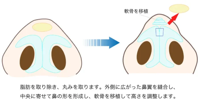鼻尖形成の