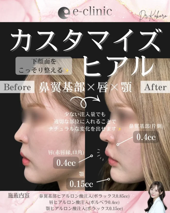 eクリニック富山院のヒアルロン酸の症例写真（名医の上坂こころ医師が執刀）（顎ヒアルロン酸）（リップヒアル）（基部ヒアル）