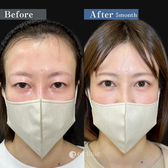 二重切開法_たるみ取り併用全切開二重＋眼瞼下垂（全顔）（伊藤渉）（202）
