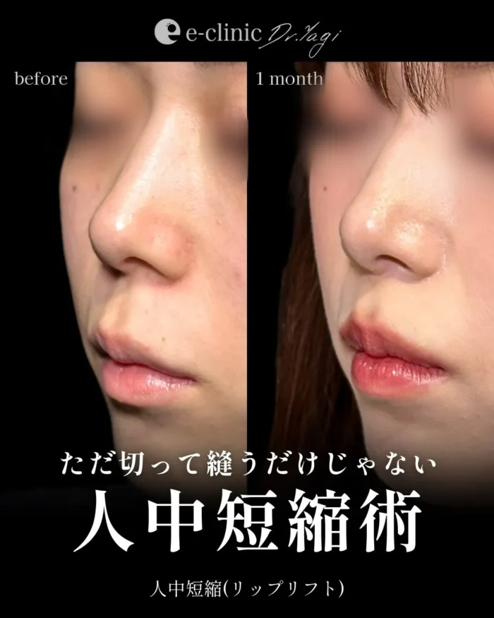 人中短縮（名医の八木良太医師が執刀）