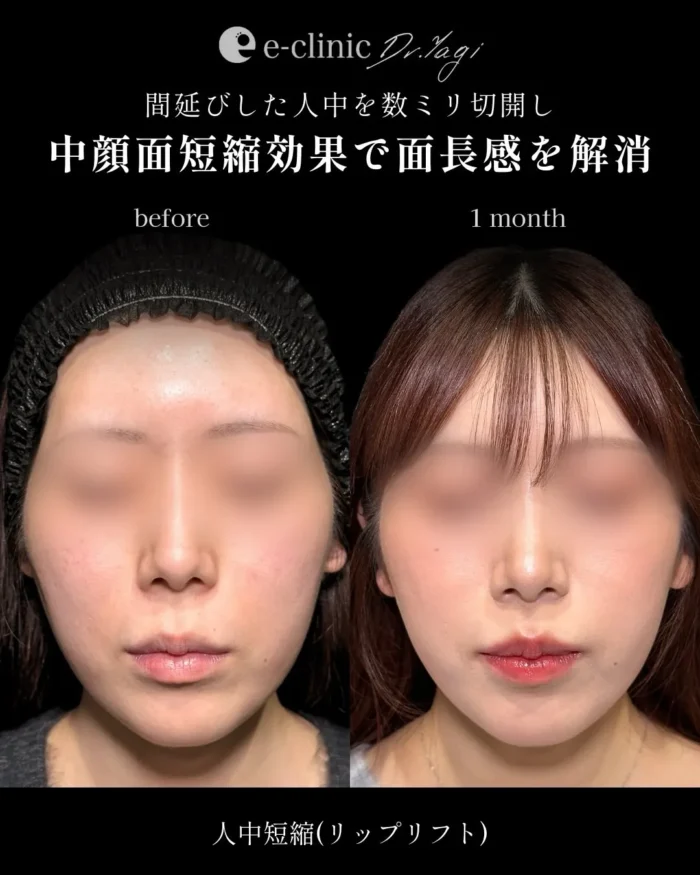 人中短縮（名医の八木良太医師が執刀）