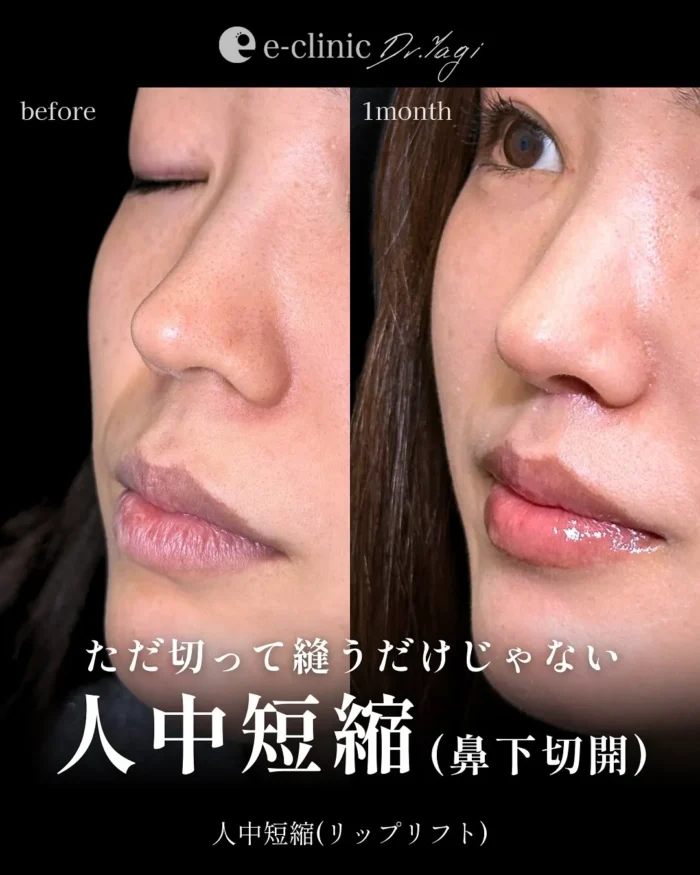 人中短縮（名医の八木良太医師が執刀）