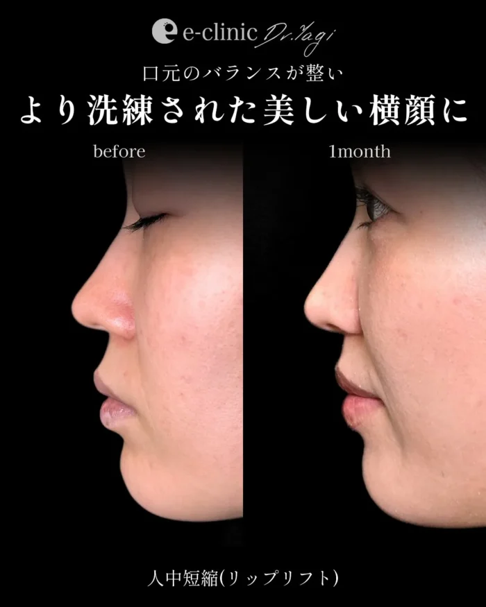 人中短縮（名医の八木良太医師が執刀）