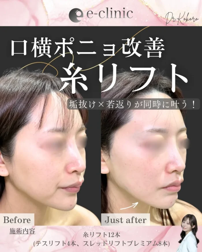 eクリニック富山院の糸リフトの症例写真（名医の上坂こころ医師が執刀）