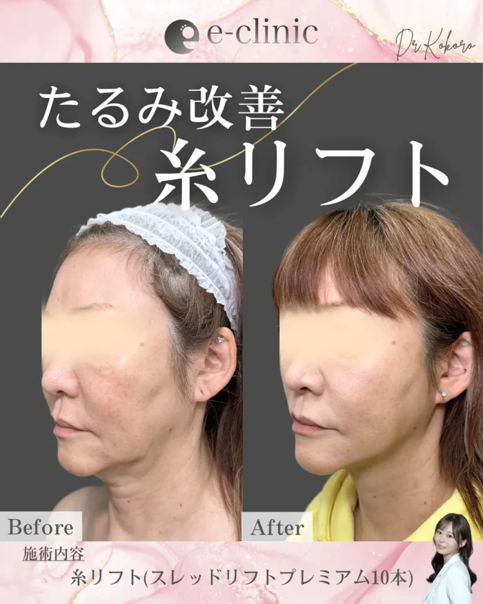 eクリニック富山院の糸リフトの症例写真（名医の上坂こころ医師が執刀）