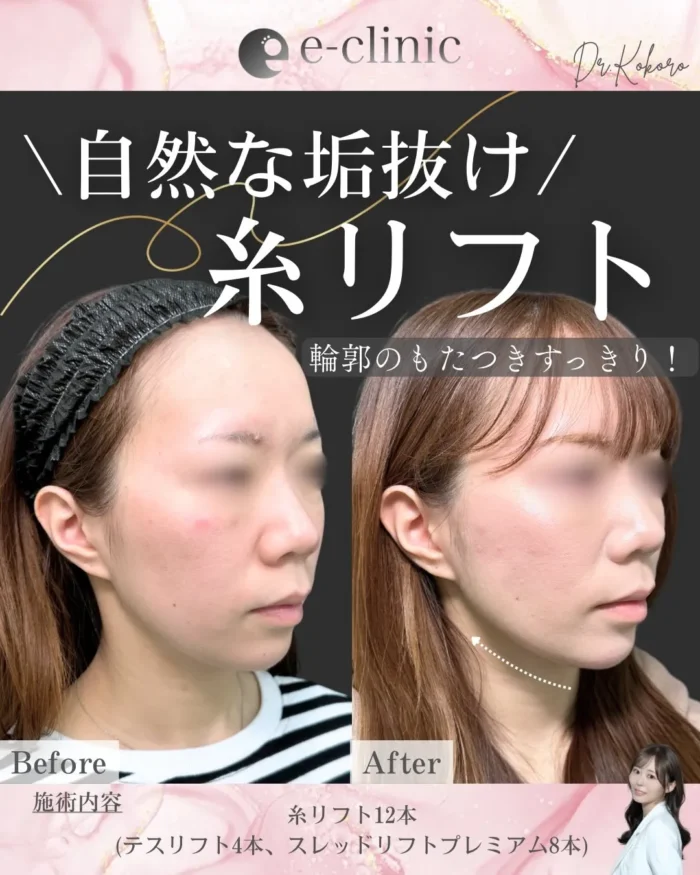 eクリニック富山院の糸リフトの症例写真（名医の上坂こころ医師が執刀）