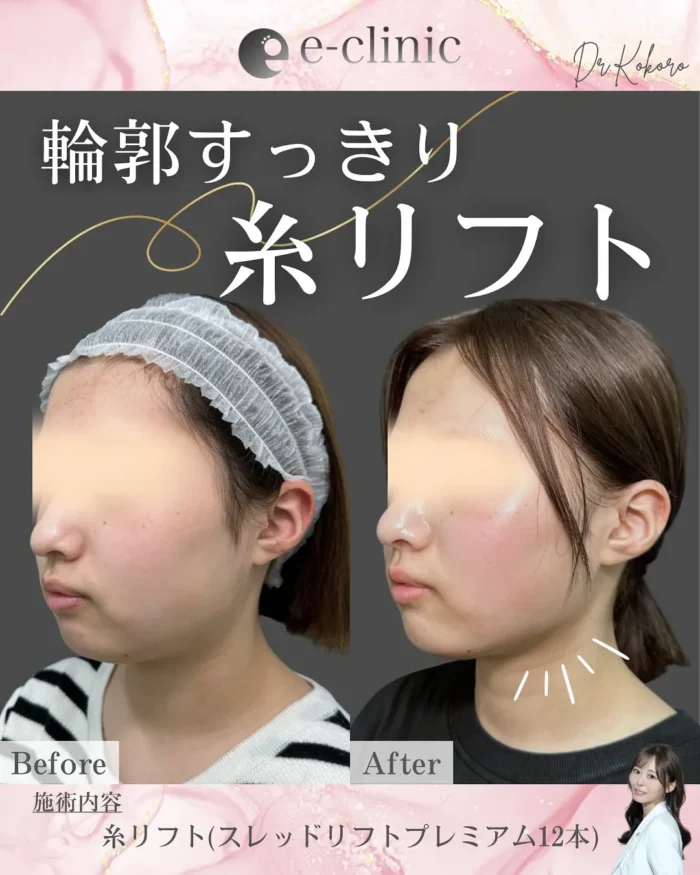 eクリニック富山院の糸リフトの症例写真（名医の上坂こころ医師が執刀）