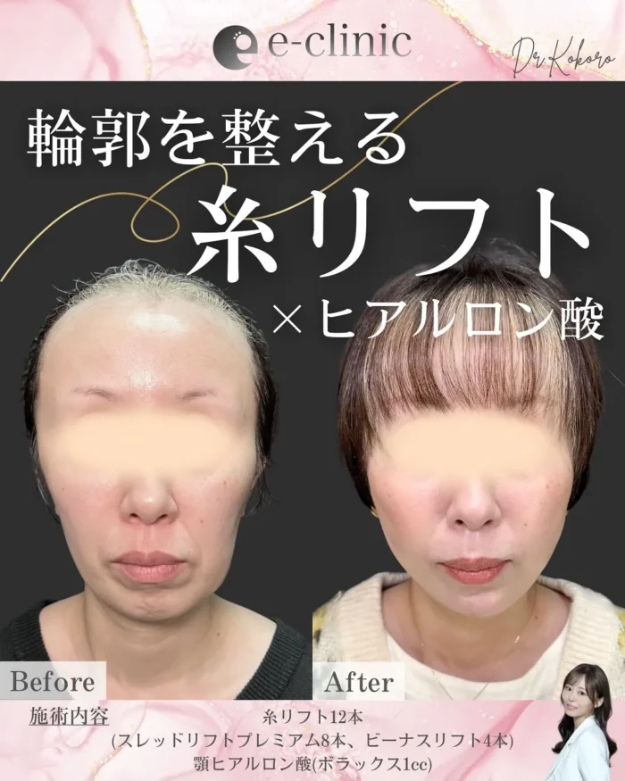 eクリニック富山院の糸リフト＋ヒアルロン酸の症例写真（名医の上坂こころ医師が執刀）