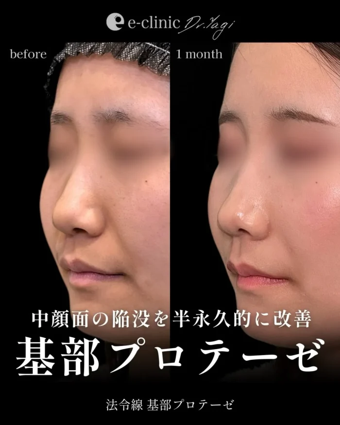 貴族手術（名医の八木良太医師が執刀）