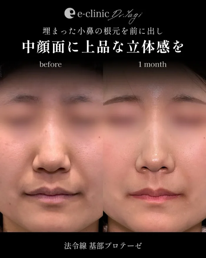 貴族手術（名医の八木良太医師が執刀）