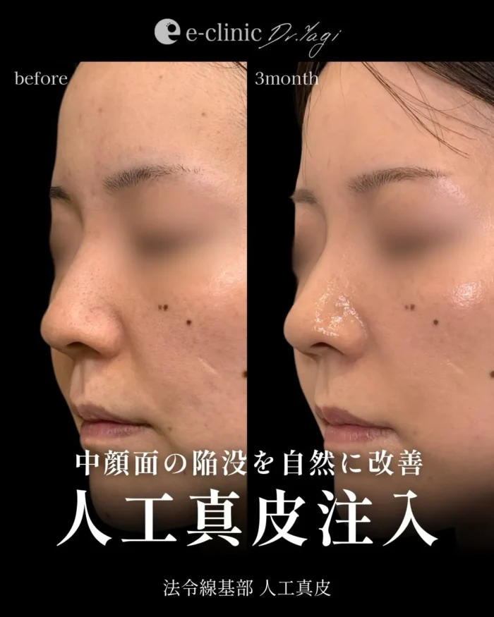 貴族手術（名医の八木良太医師が執刀）