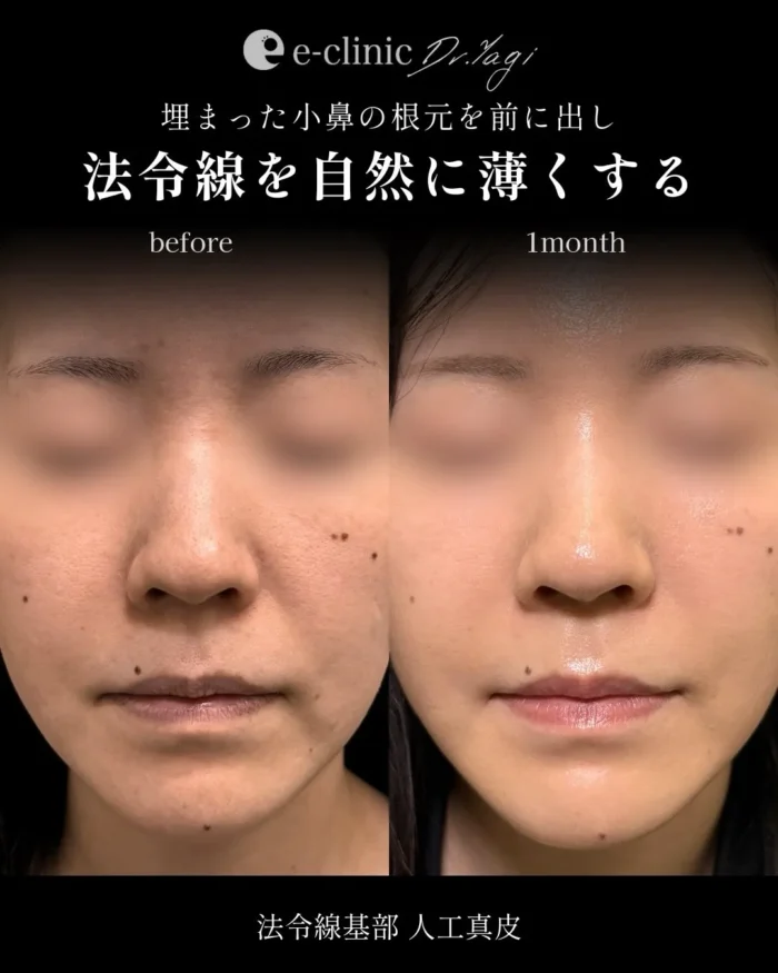 貴族手術（名医の八木良太医師が執刀）