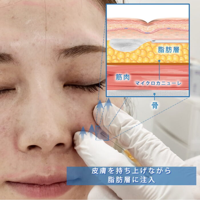 頬のヒアルロン酸の注入方法の図解