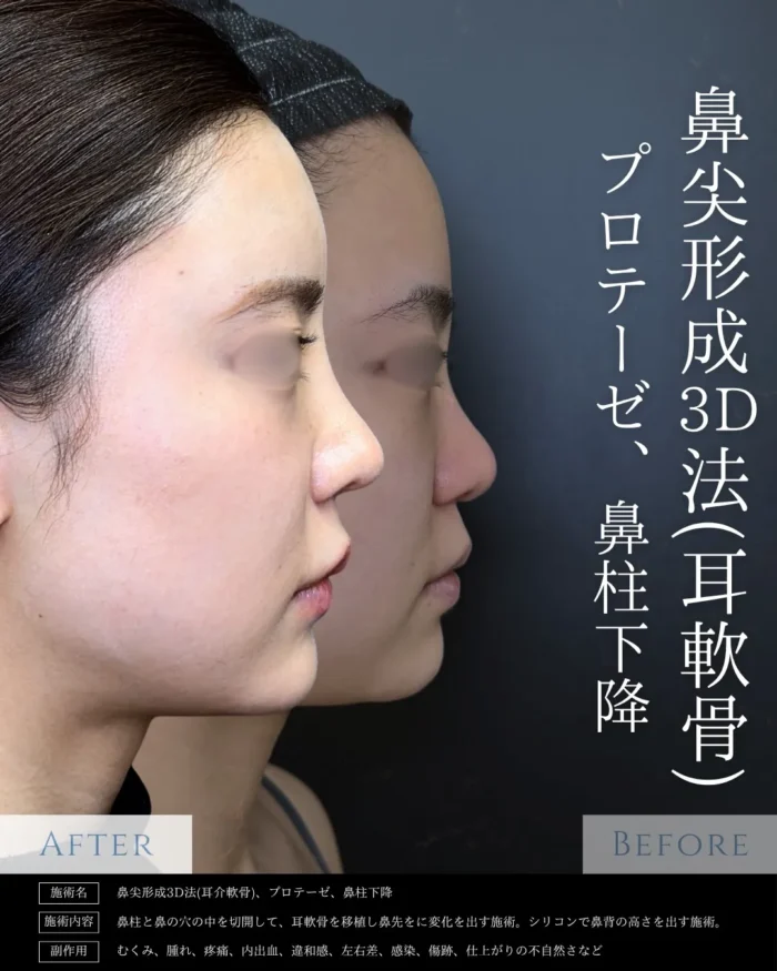 鼻整形_鼻尖形成3D法＋耳介軟骨移植＋プロテーゼ＋鼻柱下降術（額）（eクリニック新宿院の鼻整形の名医「相原隆光」医師が執刀）東京