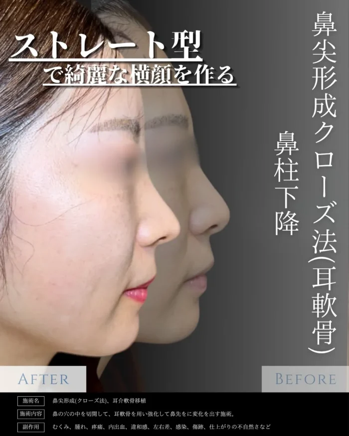 鼻整形_鼻尖形成3D法＋耳介軟骨移植＋鼻柱下降術（eクリニック新宿院の鼻整形の名医「相原隆光」医師が執刀）東京