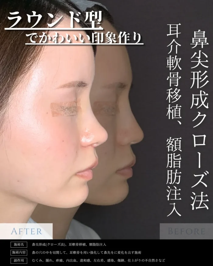 鼻整形_鼻尖形成クローズ法＋耳介軟骨移植＋鼻柱下降術＋脂肪注入（額）（eクリニック新宿院の鼻整形の名医「相原隆光」医師が執刀）東京