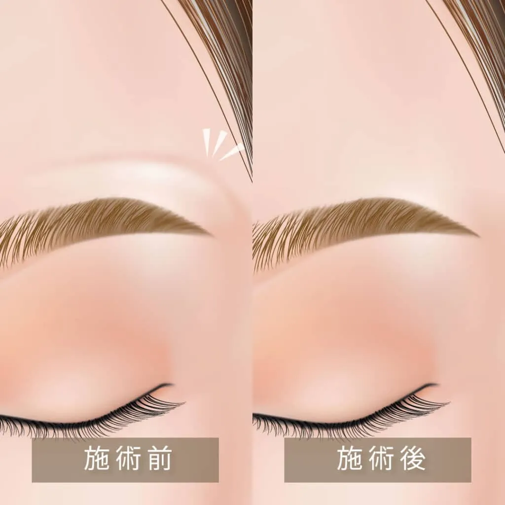 眉上ボトックスのイメージ