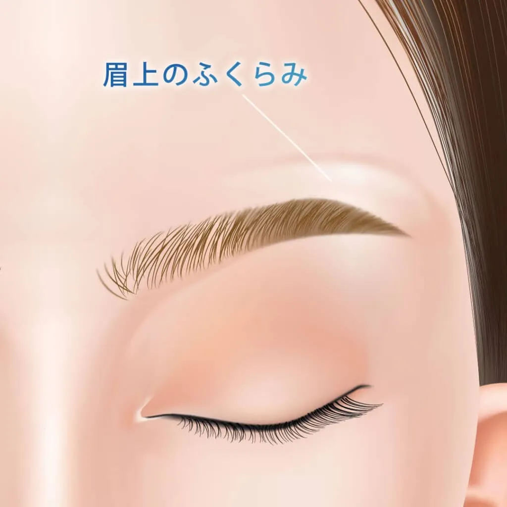 眉上ボトックスの図解