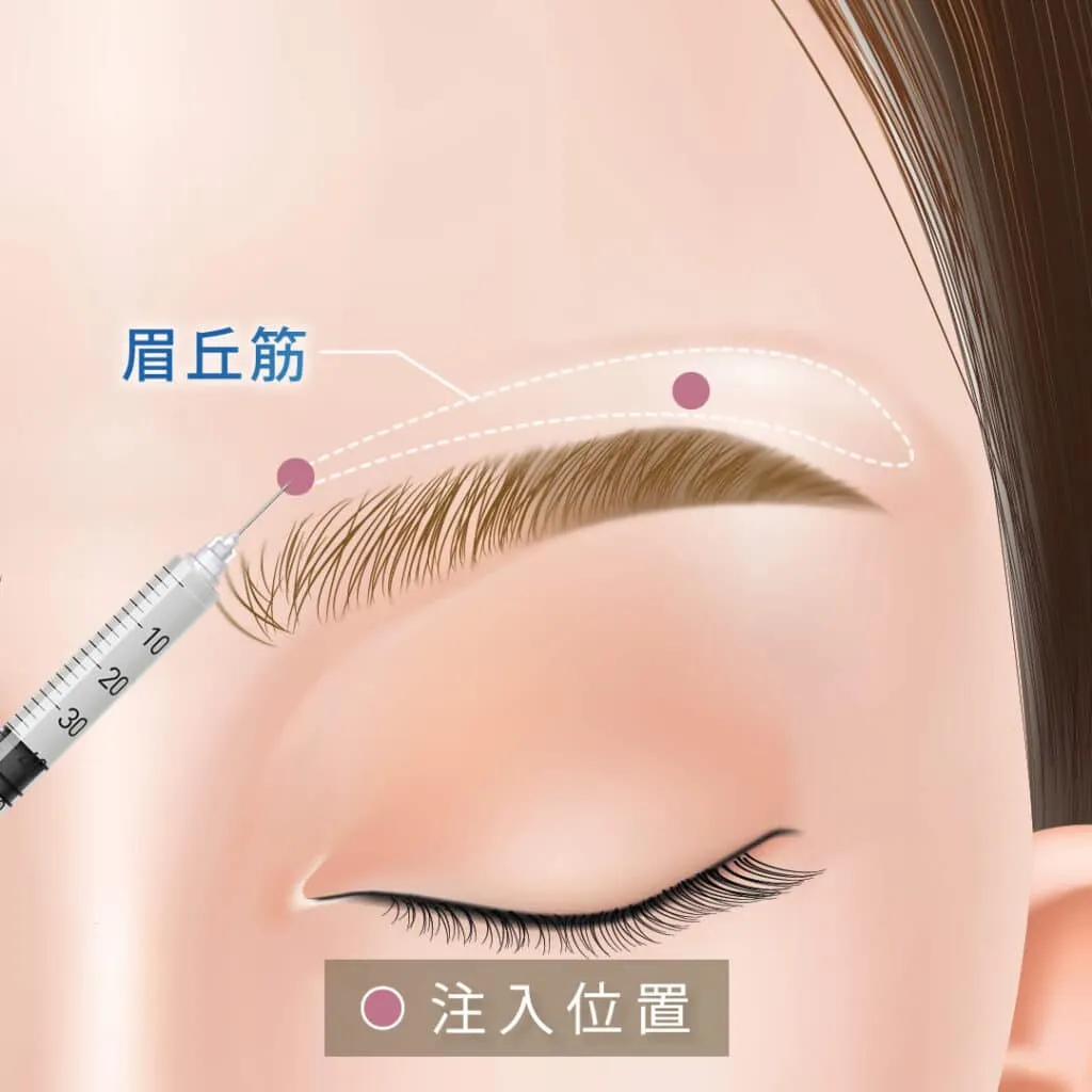 眉上ボトックスの図解2