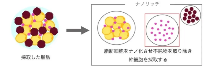 脂肪注入_ナノリッチ
