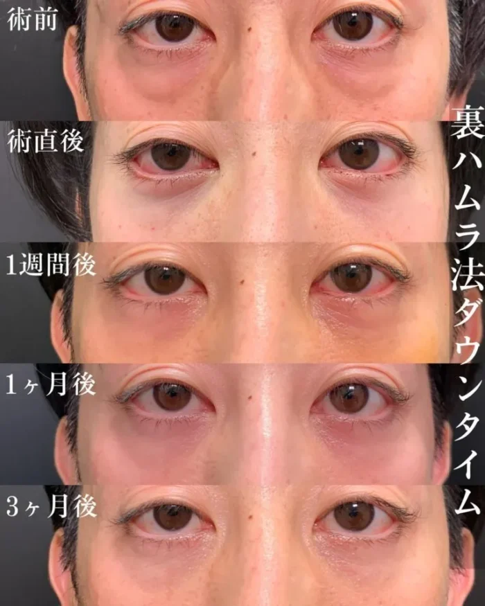 裏ハムラ法のダウンタイム経過
