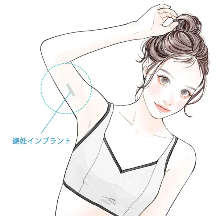避妊インプラント挿入イメージ