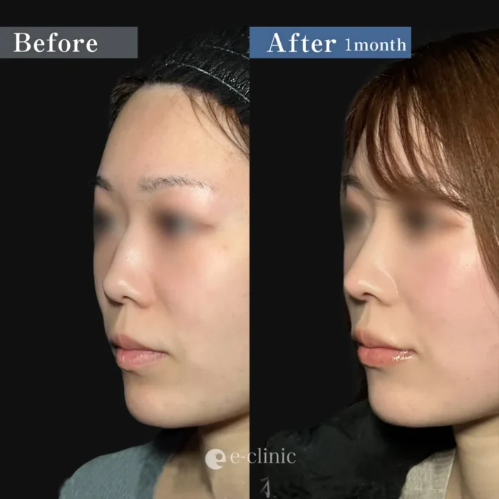 鼻整形_鼻中隔延長＋鼻尖形成3D法＋鷲鼻修正＋鼻唇角形成（猫手術）（服部健人）（269-2）斜め顔