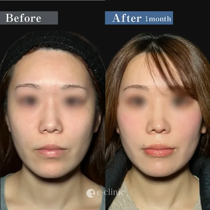 鼻整形_鼻中隔延長＋鼻尖形成3D法＋鷲鼻修正＋鼻唇角形成（猫手術）（服部健人）（269-3）正面