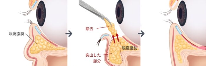 経結膜脱脂の図解