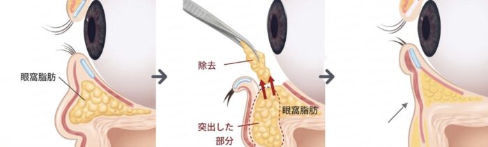 経結膜脱脂＋脂肪注入の図解