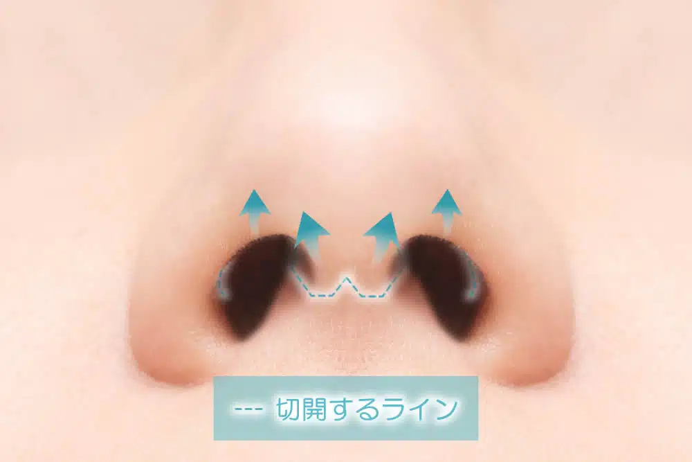 鼻整形/鼻尖形成/オープン法の切開するライン
