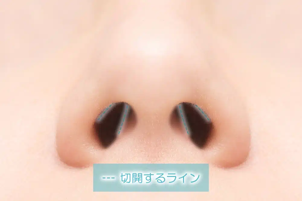 鼻整形/鼻尖形成/クローズ法の切開するライン