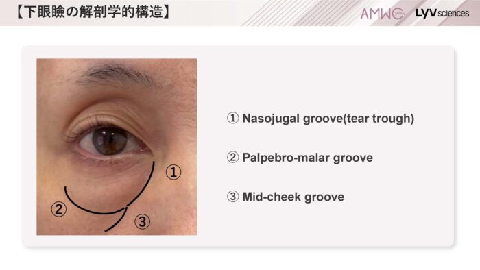 9_経結膜的眼窩脂肪移動術（裏ハムラ法）とは