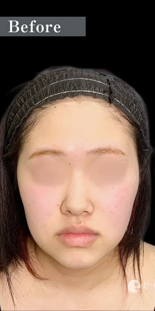 脂肪吸引（顎下、頬、ジョールファット）＋糸リフト_術前正面（辻一七子）（205）